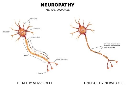 Featured image for post: Effective Treatment Options for Pain Associated with Neuropathy