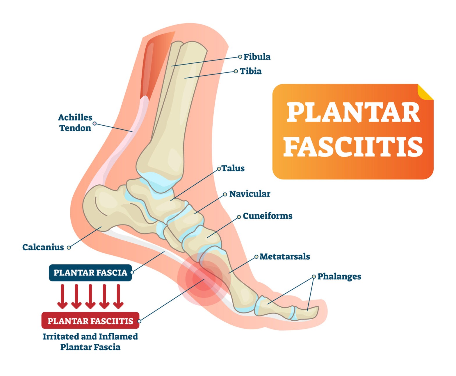 Featured image for post: Plantar Fasciitis